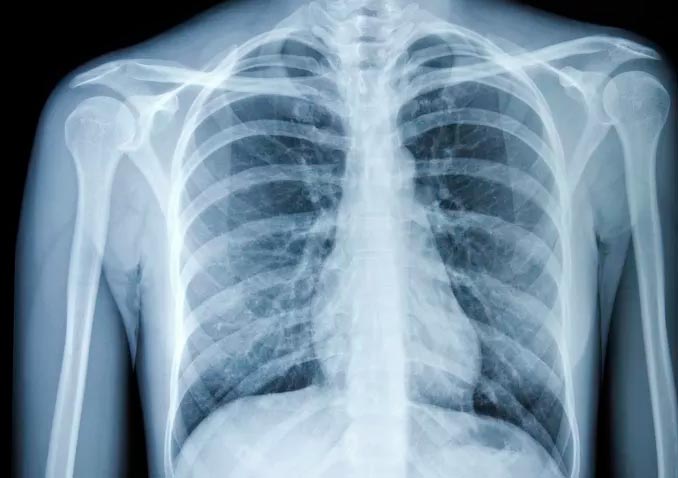 Critical Care Suite который анализирует рентген грудной клетки одобрен FDA