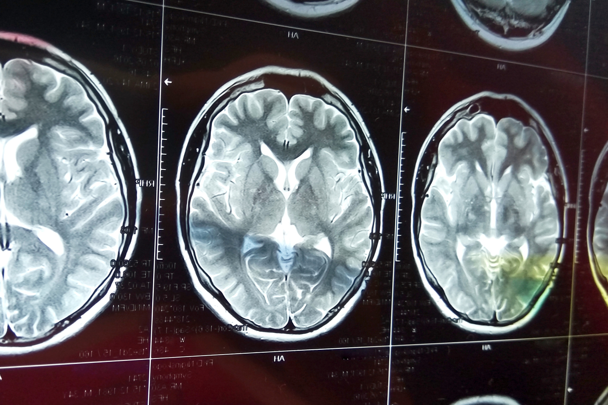 В будущем психиатрическая помощь может включать диагностику с помощью сканирования мозга